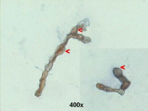 هایفی قهوه‌ای رنگ مربوط به قارچ‌های دیماتیاسئوس را در تراشه‌ی قرنیه نشان می‌دهد