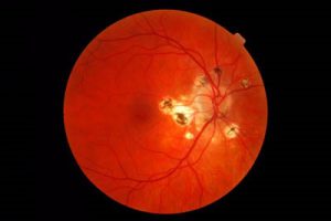 عفونتهای قارچی چشم