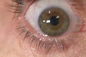 مروری بر عفونتهای قارچی چشم