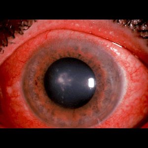 عفونتهای قارچی چشم