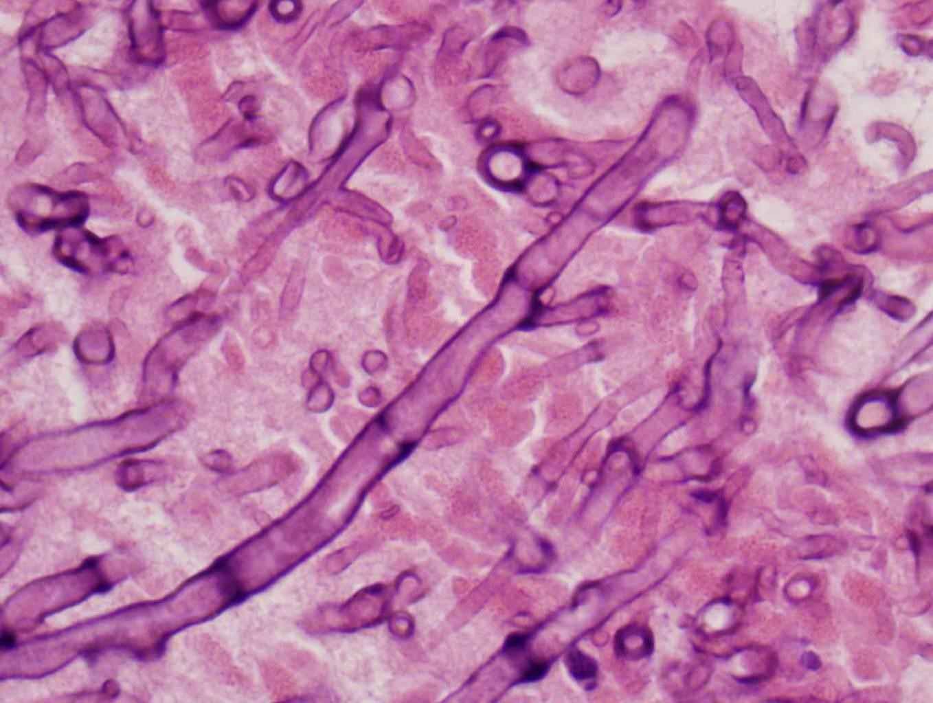 عفونت‌های قارچی در گیرندگان پیوند اعضاء جامد(2)