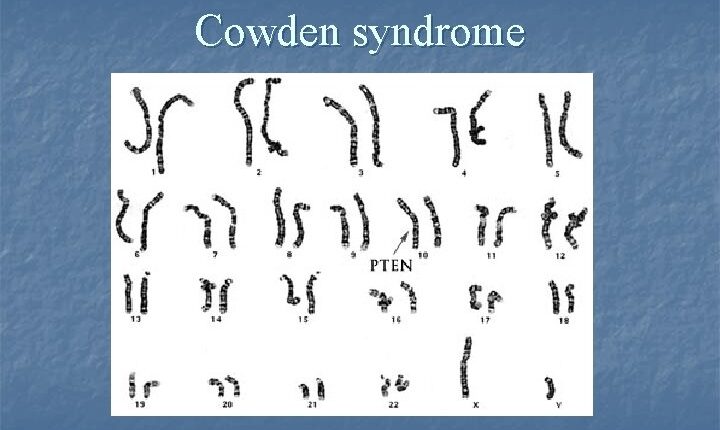 Cowden Syndrome