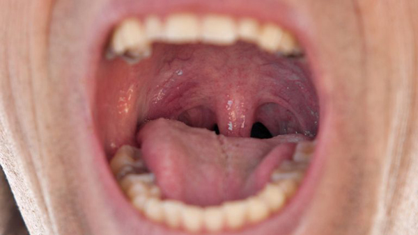 سرطان دهان
