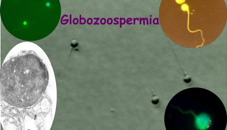 Globozoospermia Syndrome