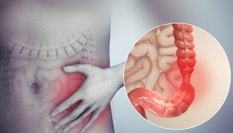 Irritable_bowel_syndrome (1)