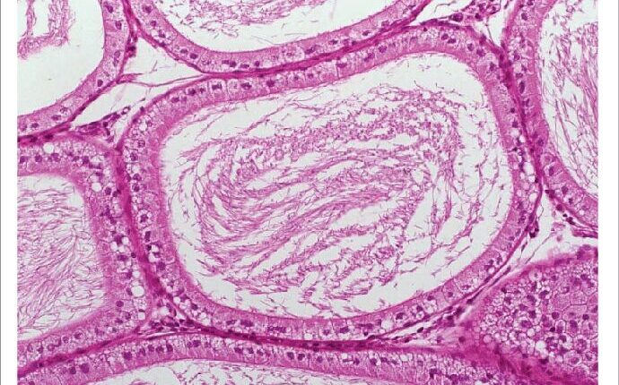 phospholipidosis