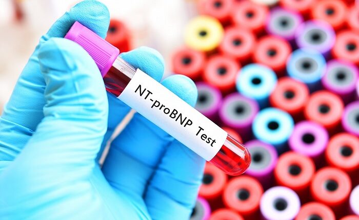 معرفی آزمایش iN-Termnal Pro B-type Natriuretic Peptide (NT-Pro BNP)