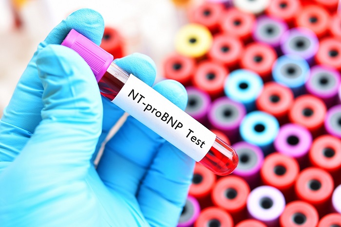 معرفی آزمایش iN-Termnal Pro B-type Natriuretic Peptide (NT-Pro BNP)