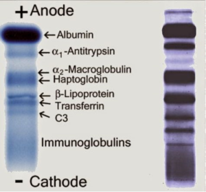 نکته‌های کلیدی آزمایشگاهی در الکتروفورز هموگلوبین، پروتئین و CSF