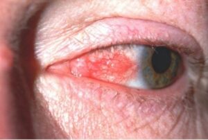 عفونت‌های ویروسی چشم