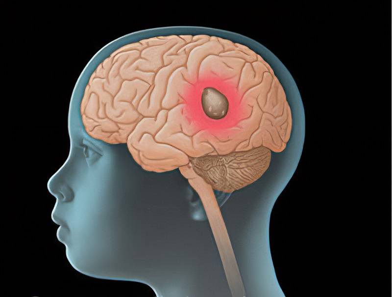 آزمایشگاه و بالین مطالعات شناسایی راهبردهای درمان بالقوه تومورهای مغزی DIPG در کودکان