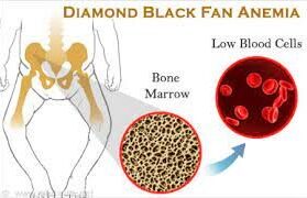 Diamond-Blackfan Anemia Syndrome