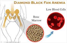 Diamond-Blackfan Anemia Syndrome